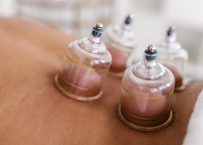 acupuncture cupping